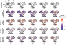 SSRI use during pregnancy alters the child’s brain development