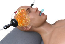 Electro-Convulsive therapy (ECT): It’s not just the memory loss.