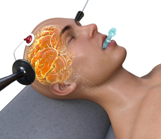 Electro-Convulsive therapy (ECT): It’s not just the memory loss.
